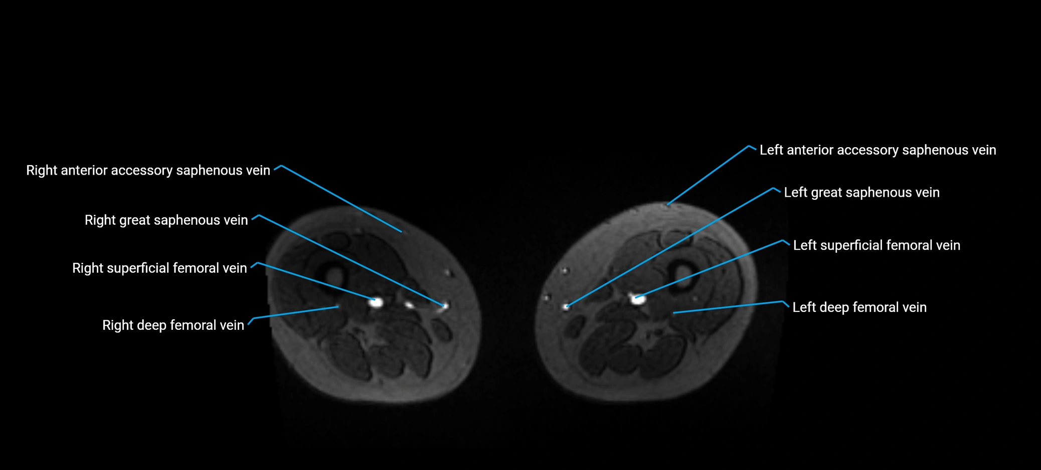 MRV abdomen pelvis & lower limb axial cross sectional anatomy labelled MRI image 298 (1).webp